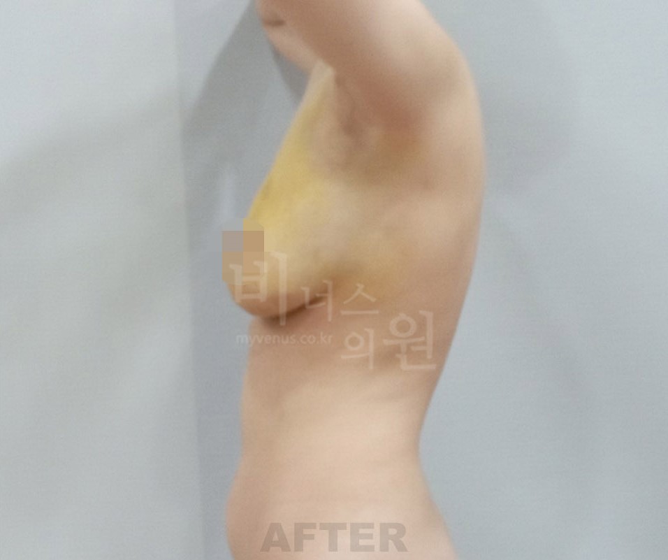 가슴 수술 후 측면 비교 1