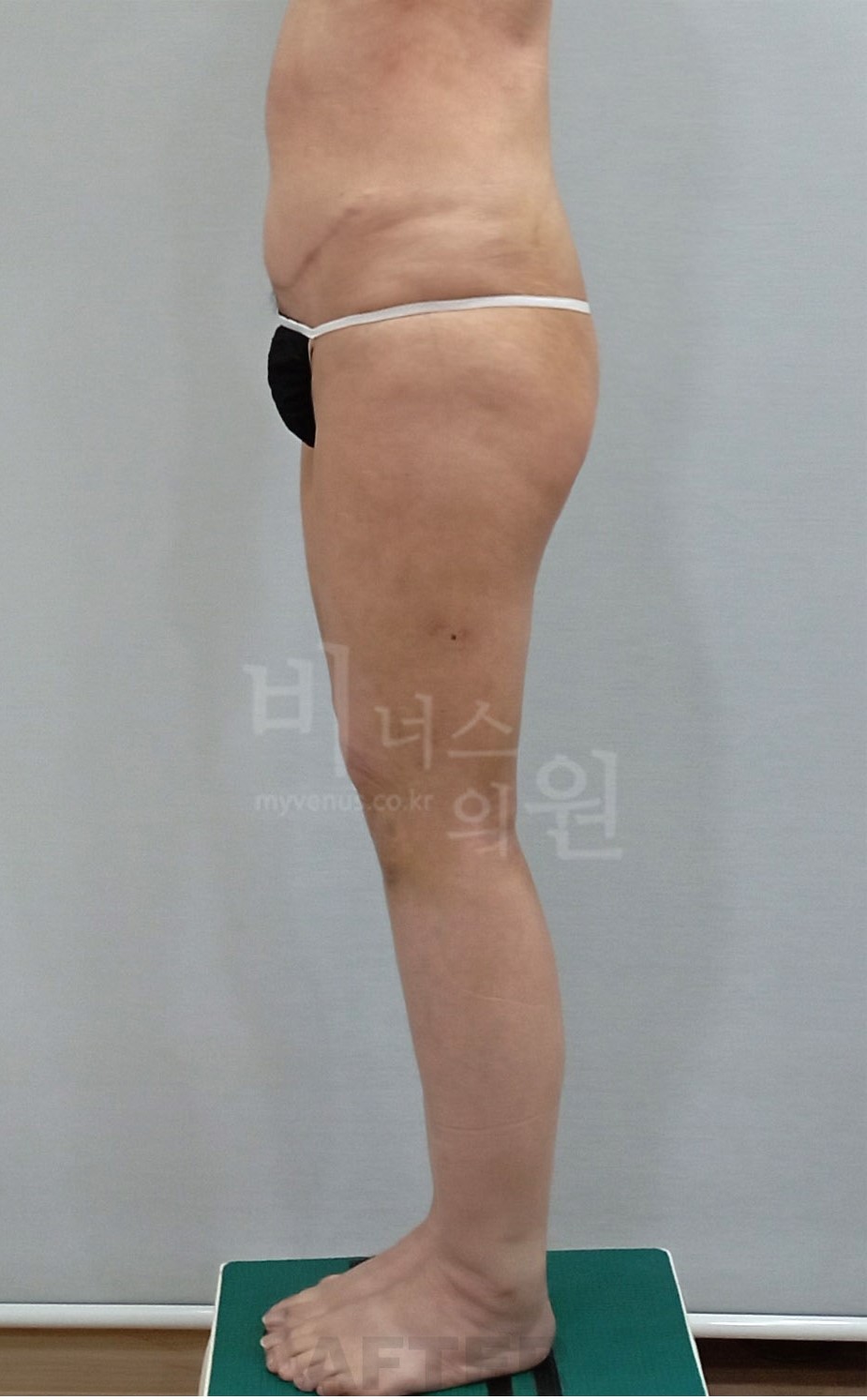 허벅지지방흡입 수술 후 측면 사진