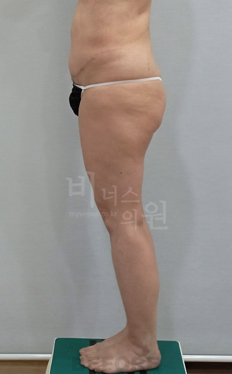 허벅지지방흡입 수술 전 측면 사진