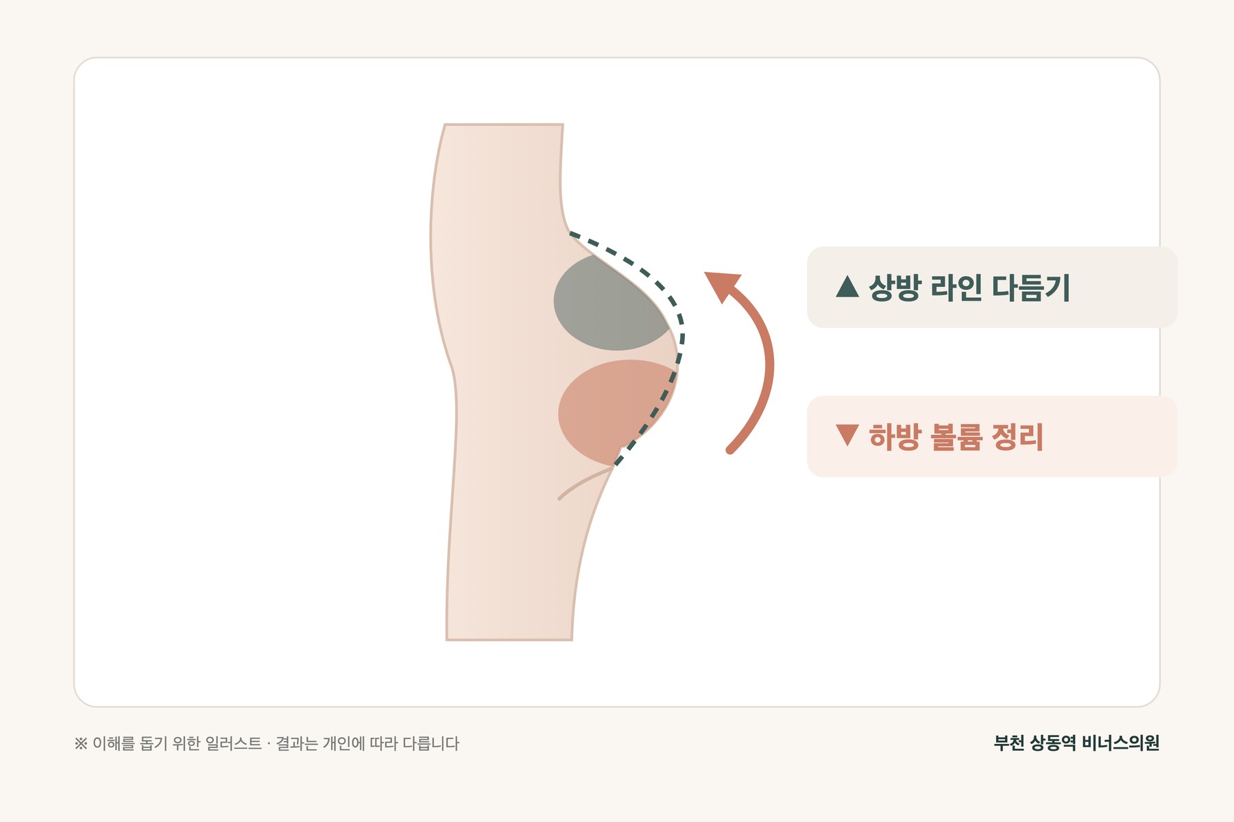 애플라인 지방흡입 — 엉덩이 하방 볼륨을 정리하고 상방 라인을 다듬는 설계를 나타낸 측면 도식