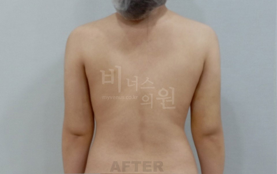 팔뚝지방흡입 수술 후 후면
