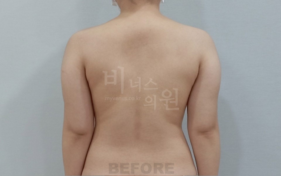 팔뚝지방흡입 수술 전 후면