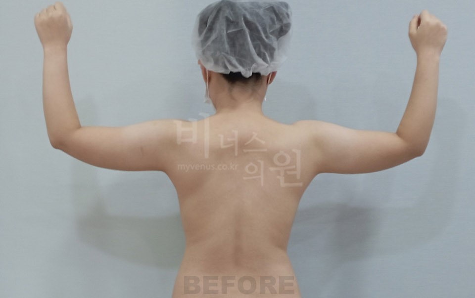 팔뚝지방흡입 수술 전 후면(팔 올림)