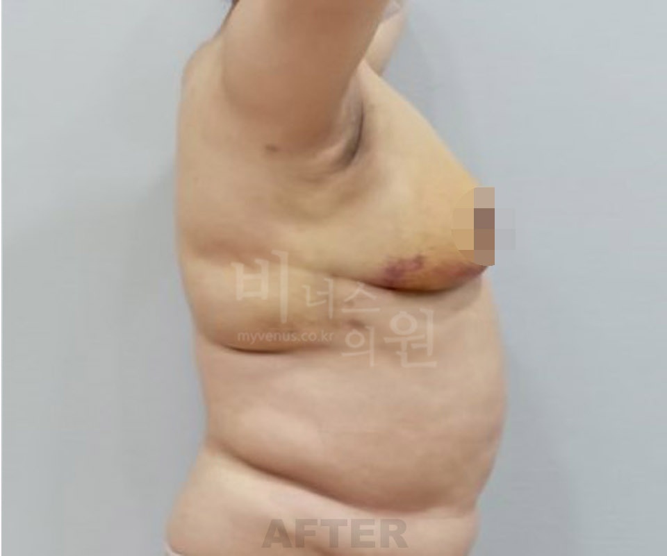 유방하수 표층 지방흡입 수술 후 측면