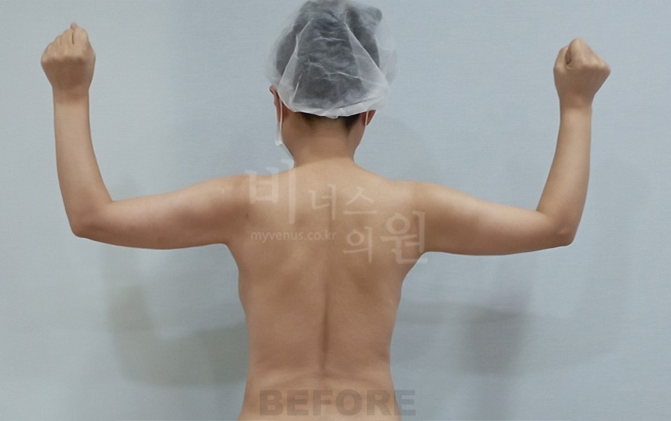 팔 지방흡입 수술 전 후면 — 팔을 올린 자세