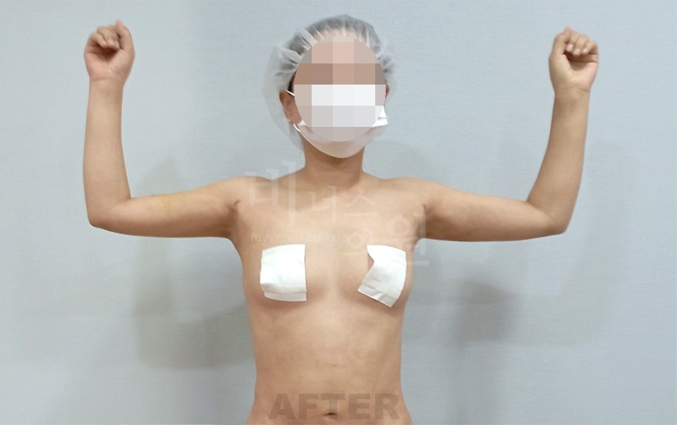 팔 지방흡입 수술 후 정면 — 팔을 올린 자세