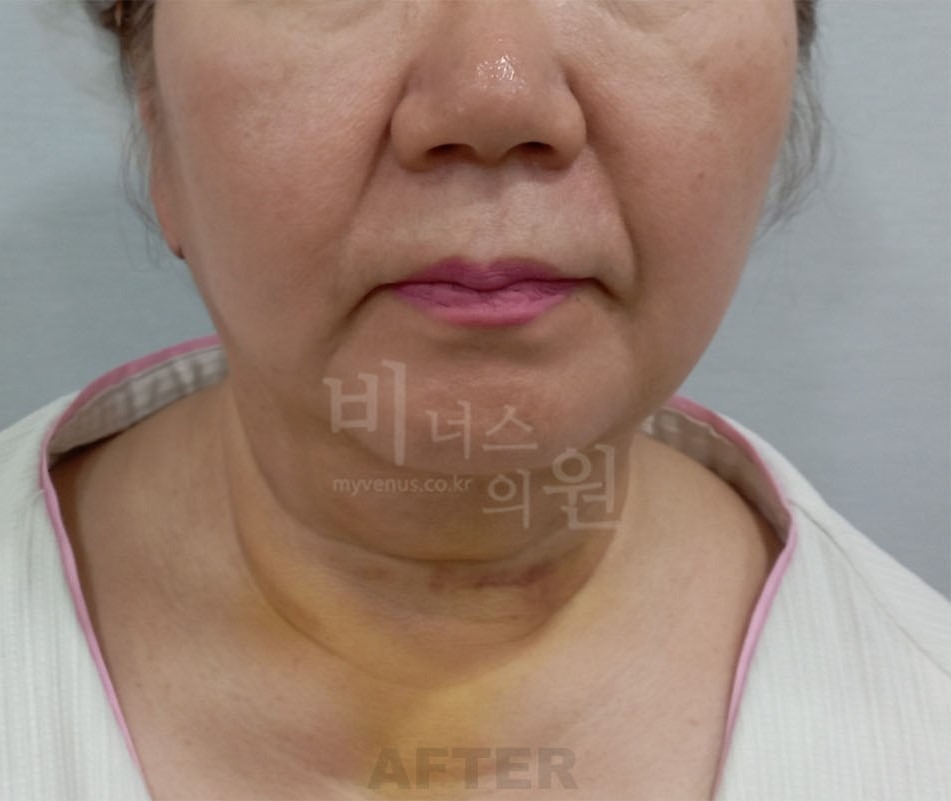 턱지방흡입 수술 후 정면 - 하안면 폭과 턱선 변화