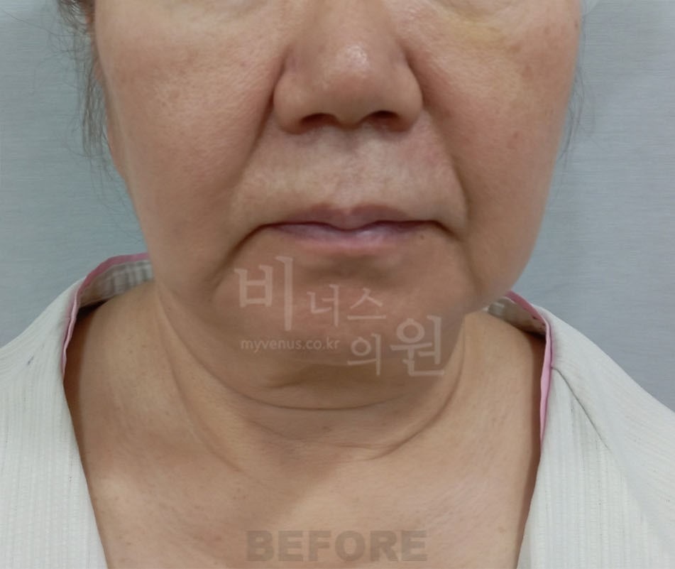 턱지방흡입 수술 전 정면 - 이중턱과 하안면 볼륨