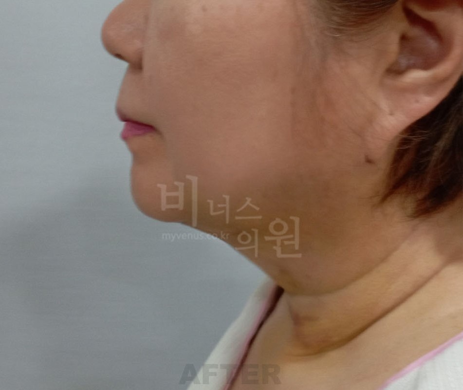 턱지방흡입 수술 후 측면 - 턱과 목 라인 변화
