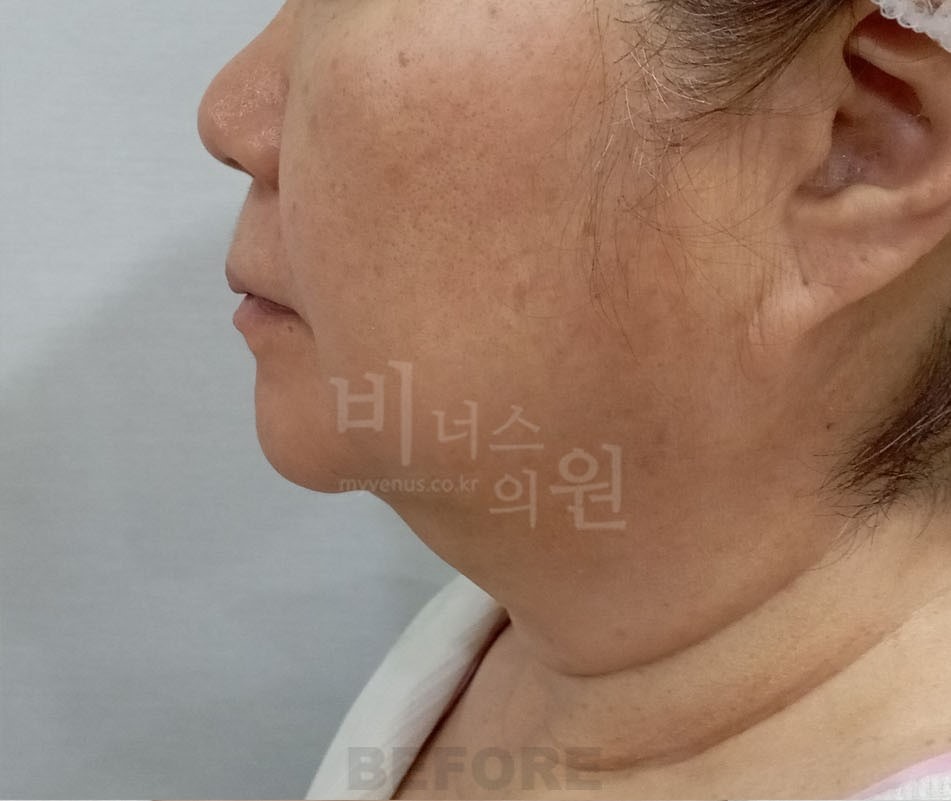 턱지방흡입 수술 전 측면 - 턱과 목 경계가 둔해 보이는 이중턱