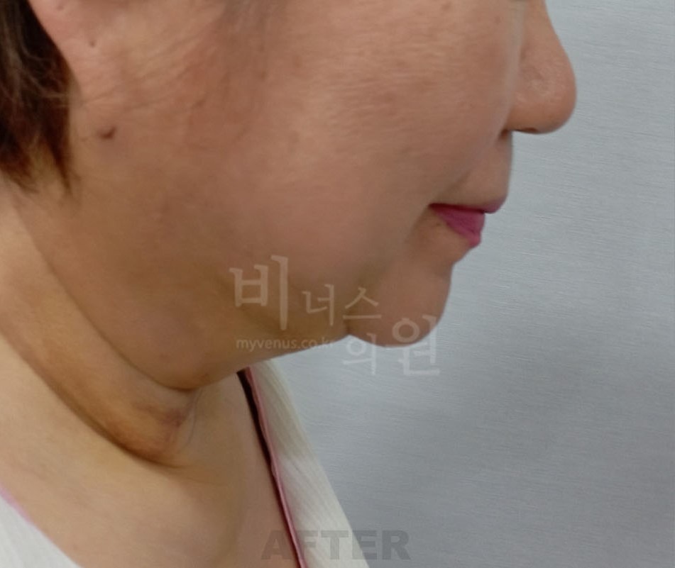 이중턱 지방흡입 수술 후 반대쪽 측면 - 턱선 변화