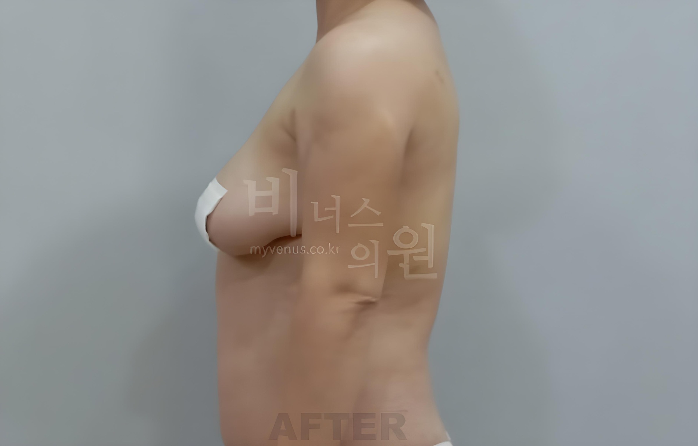 팔뚝 지방흡입 수술 후 측면 Upper arm liposuction after