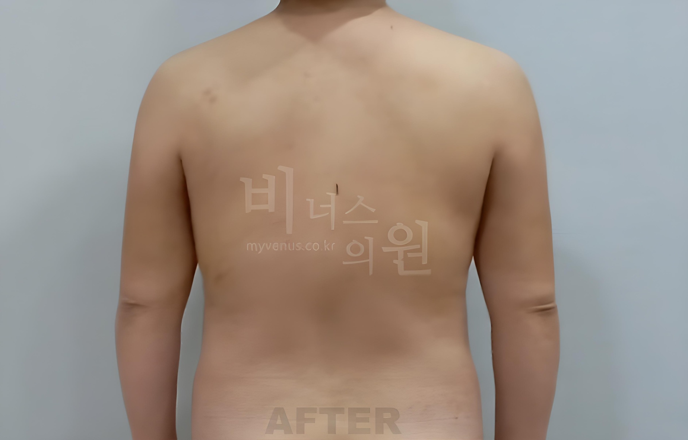 팔뚝 지방흡입 수술 후 후면 차렷 Upper arm liposuction after