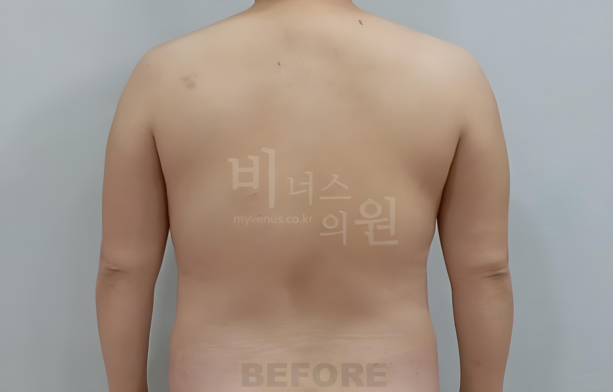팔뚝 지방흡입 수술 전 후면 차렷 Upper arm liposuction before