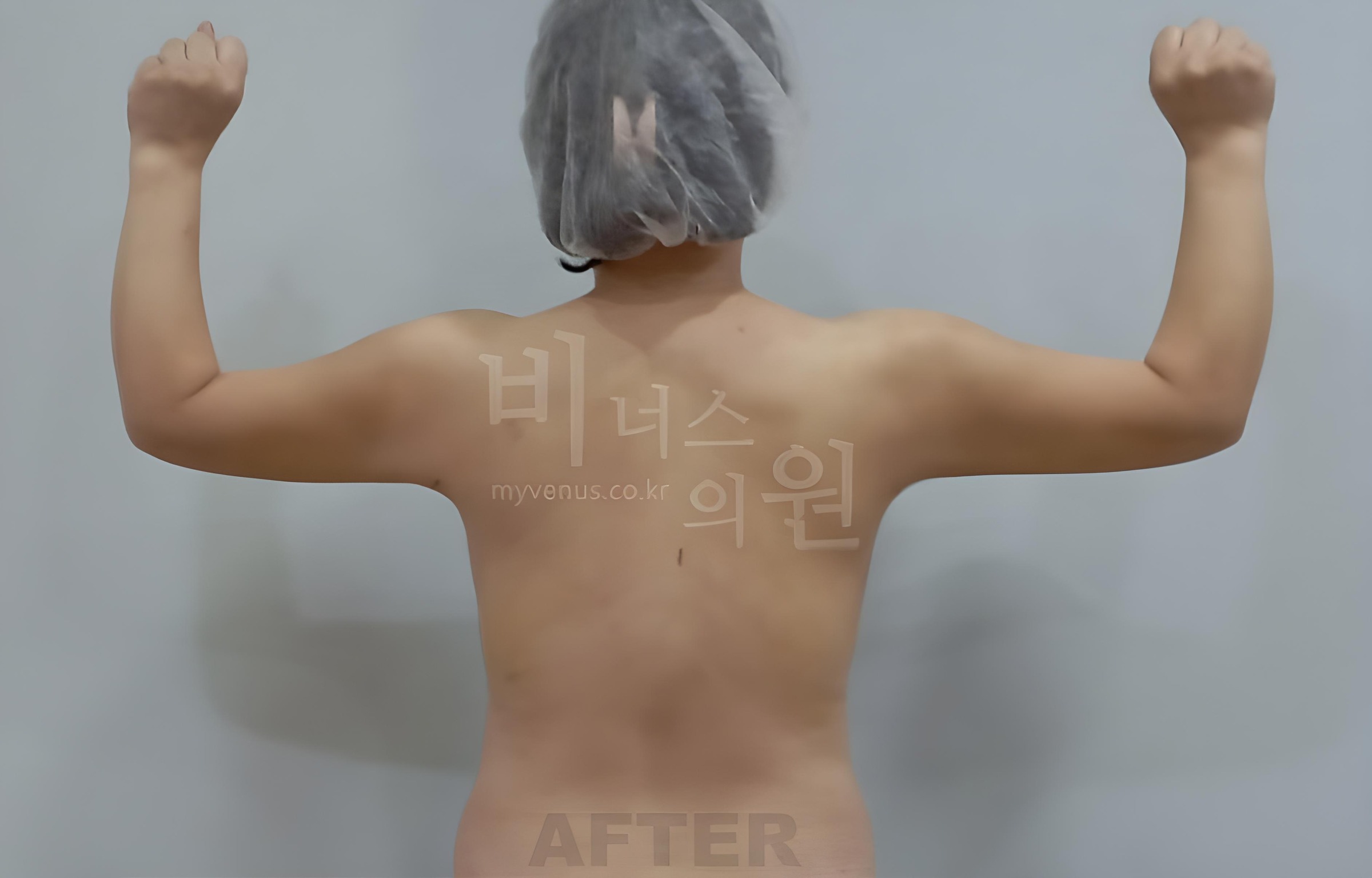 팔뚝 지방흡입 수술 후 후면 팔 올림 Upper arm liposuction after