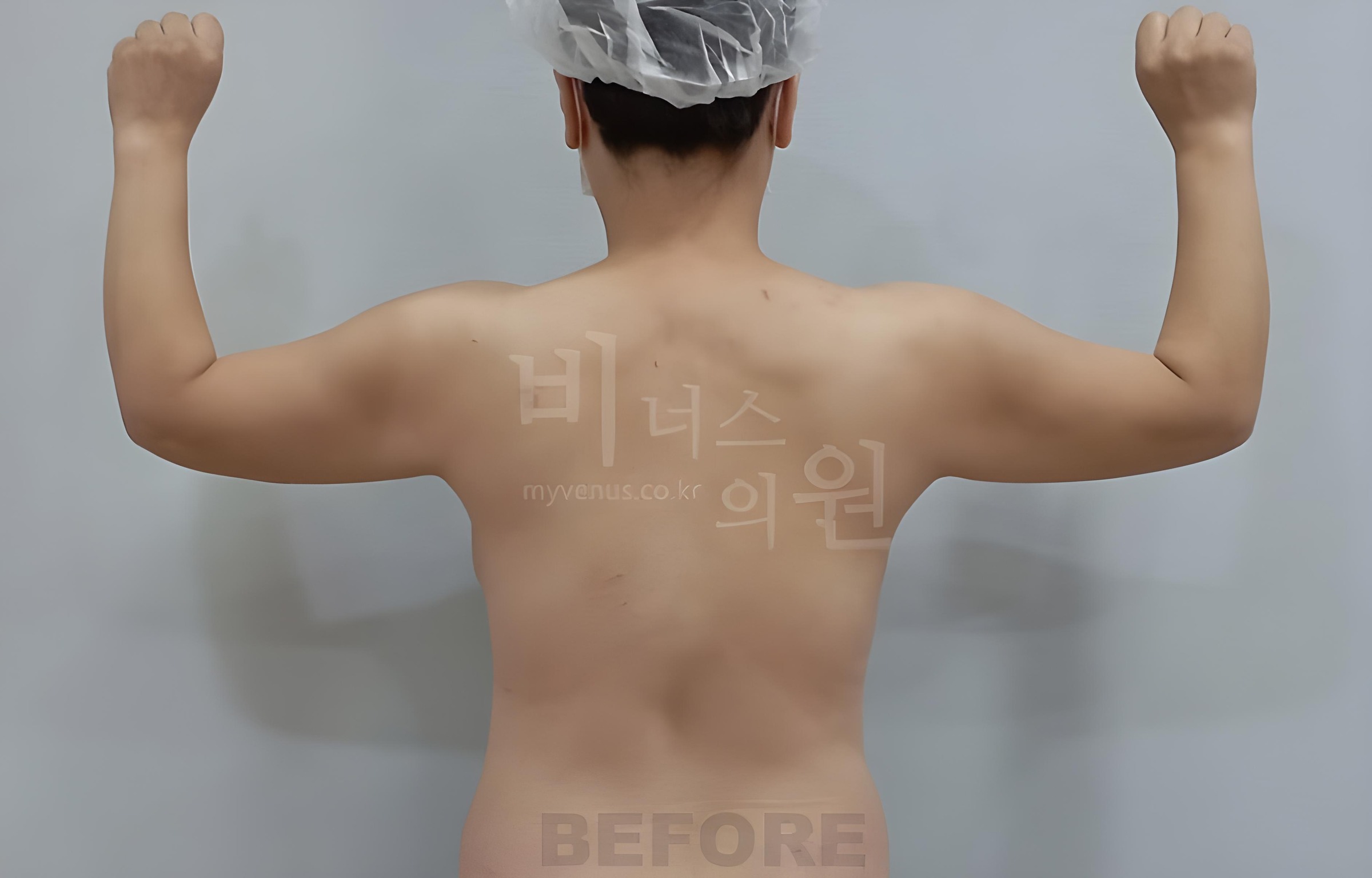 팔뚝 지방흡입 수술 전 후면 팔 올림 Upper arm liposuction before