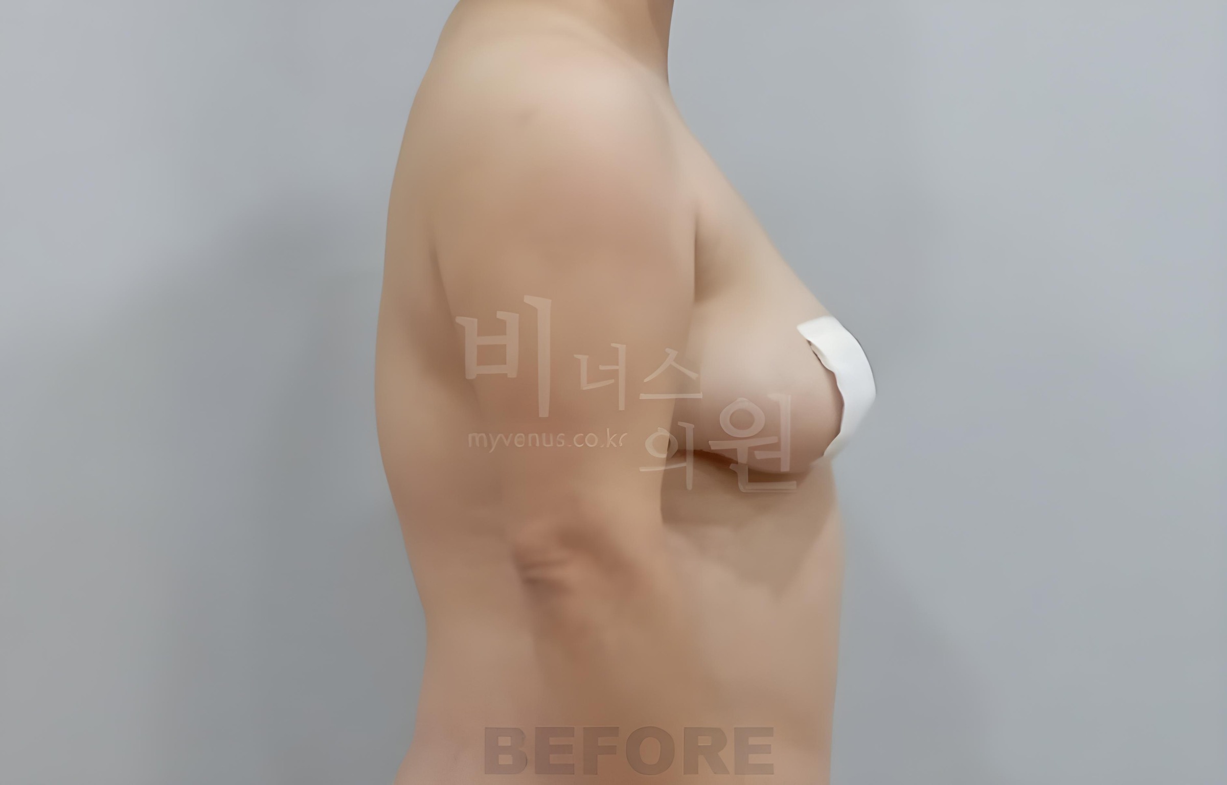 팔뚝 지방흡입 수술 전 반대쪽 측면 Upper arm liposuction before
