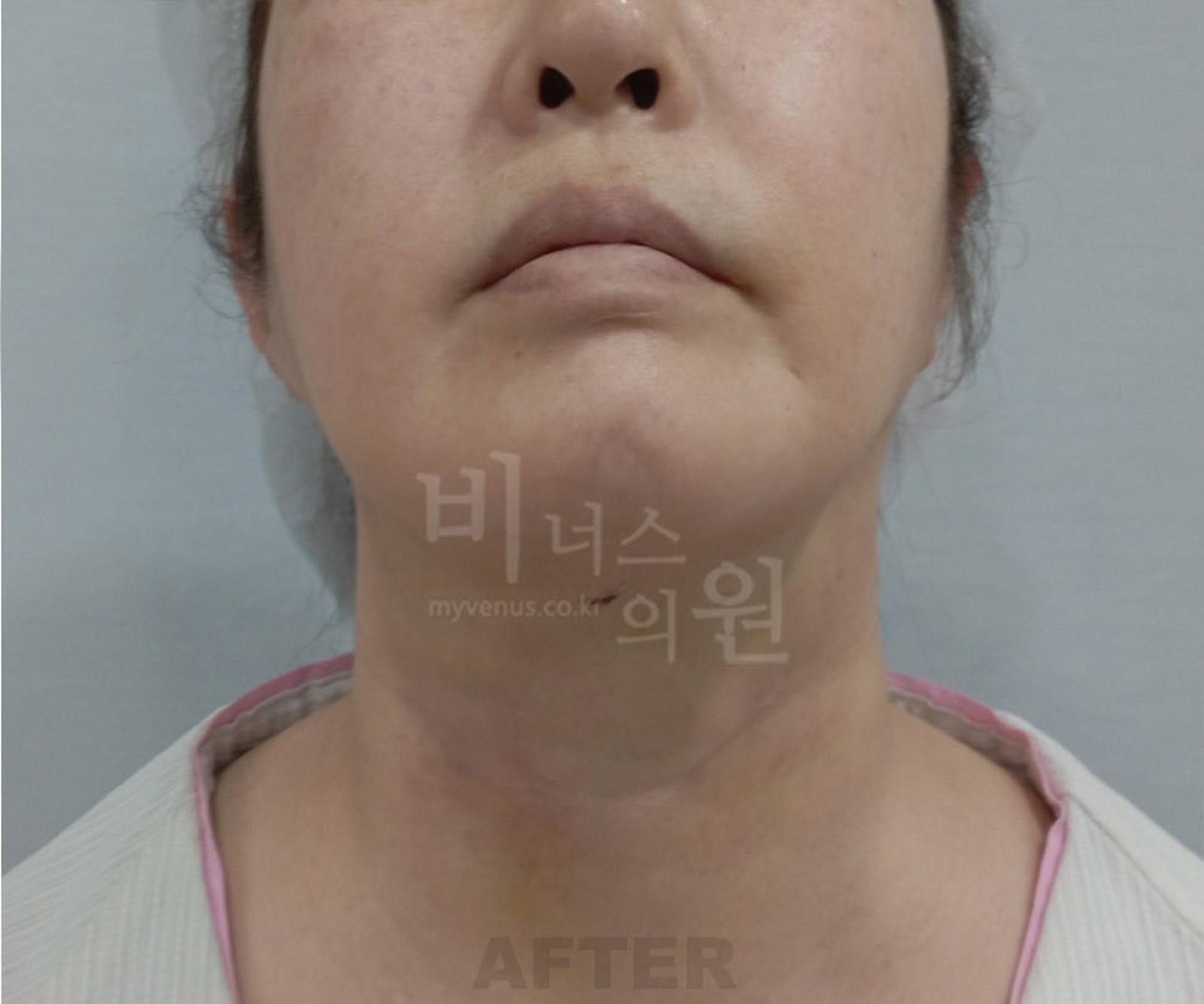 이중턱 지방흡입 수술 후 정면(턱 들기)