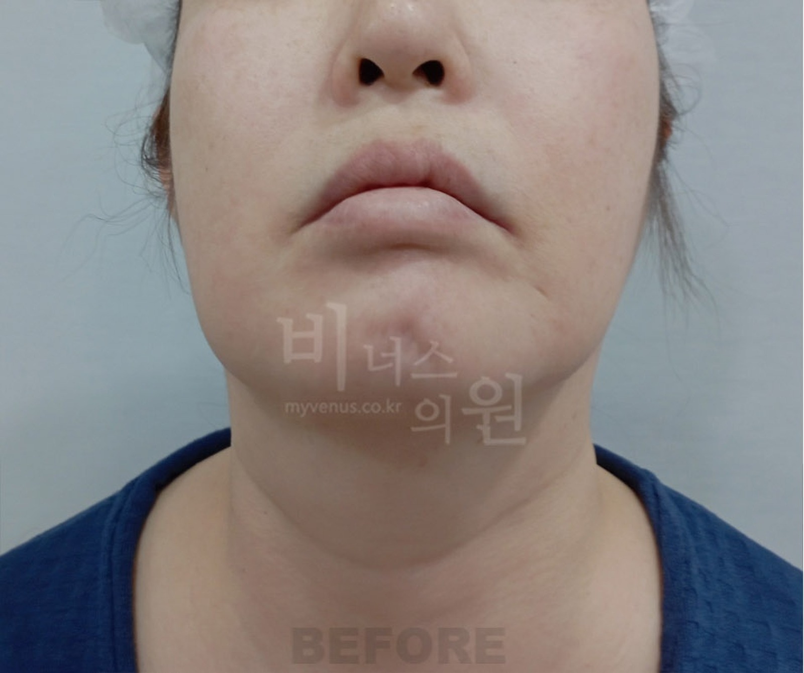 이중턱 지방흡입 수술 전 정면(턱 들기)