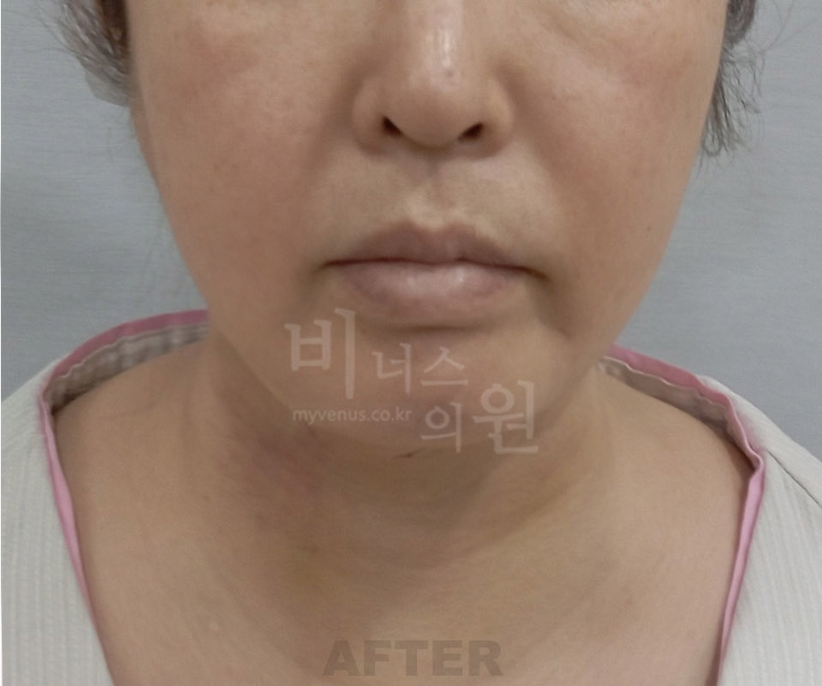 이중턱 지방흡입 수술 후 정면