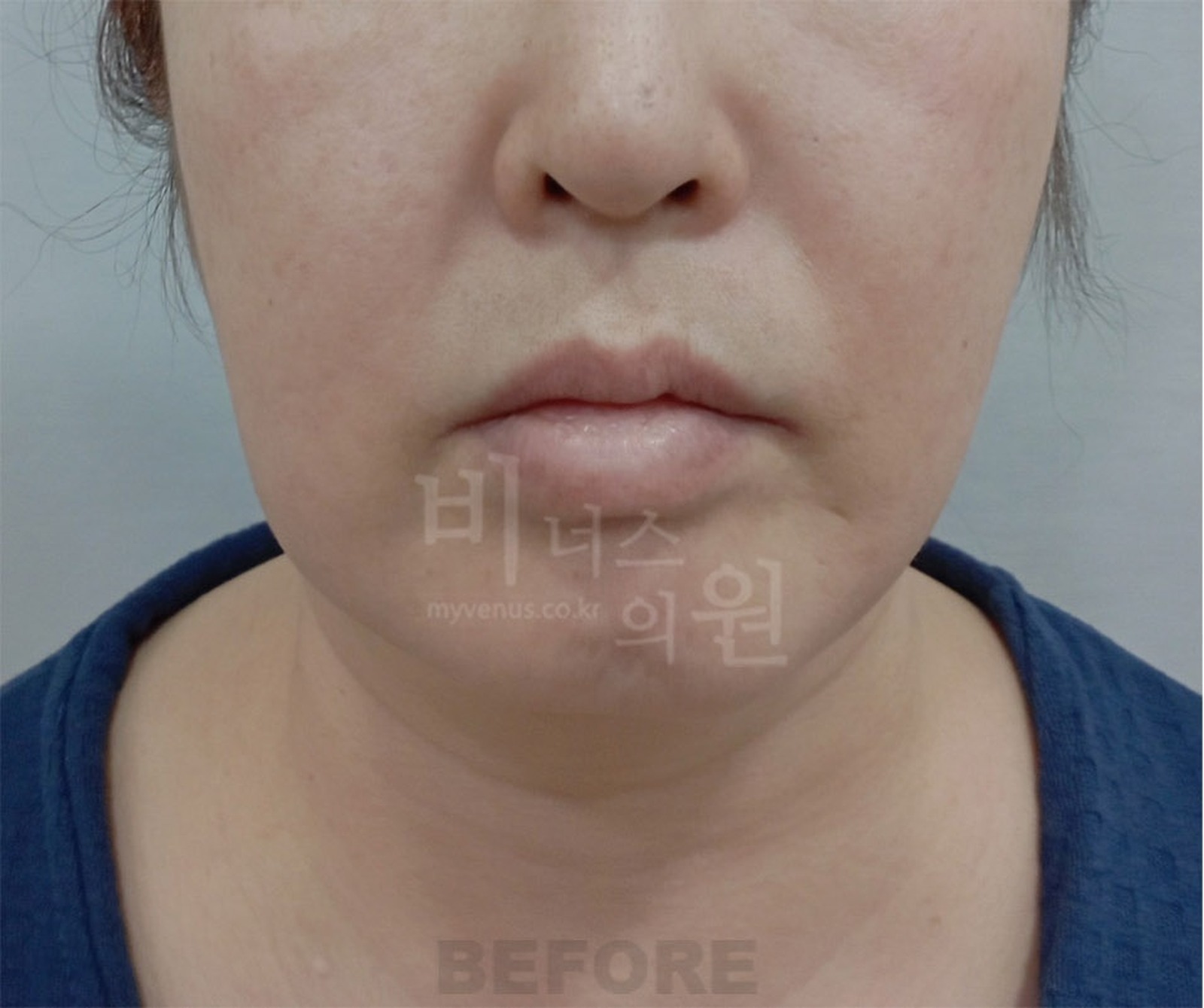 이중턱 지방흡입 수술 전 정면