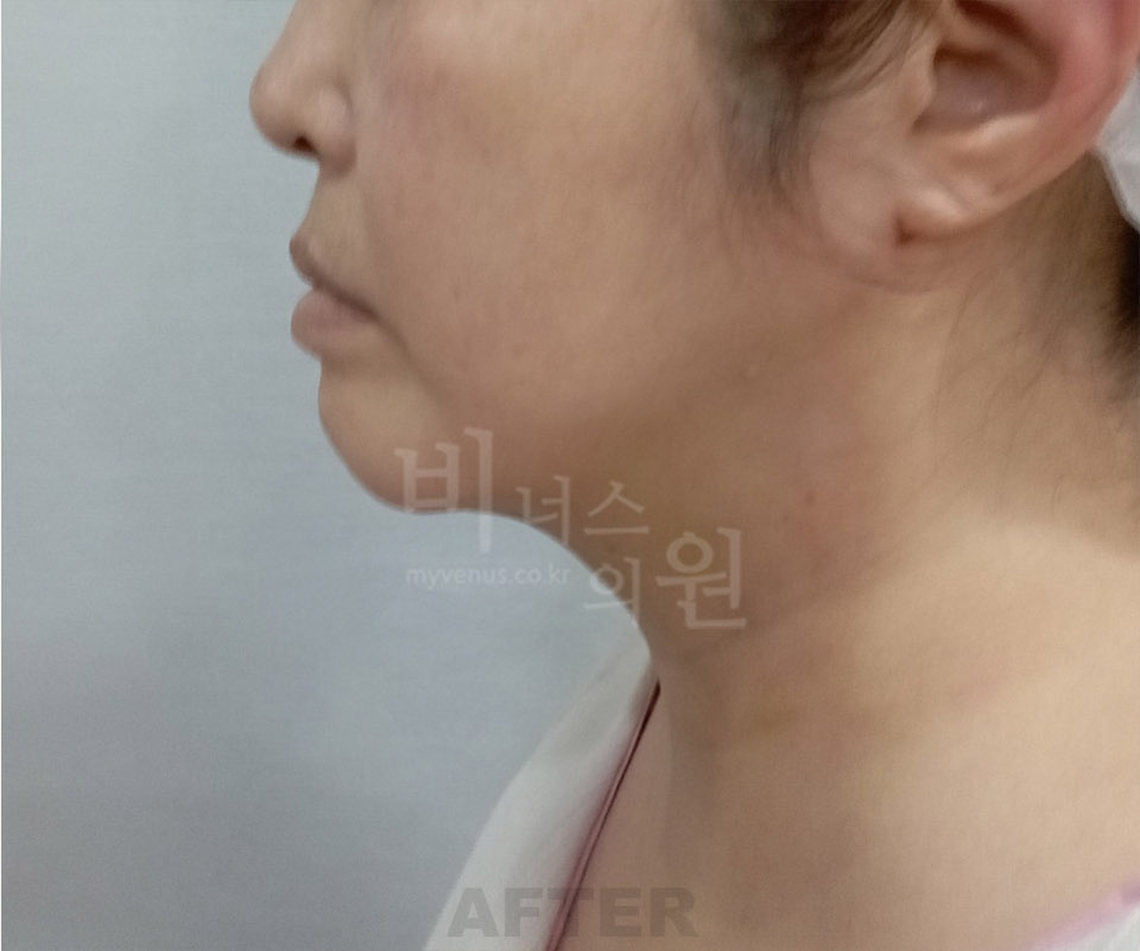 이중턱 지방흡입 수술 후 좌측면