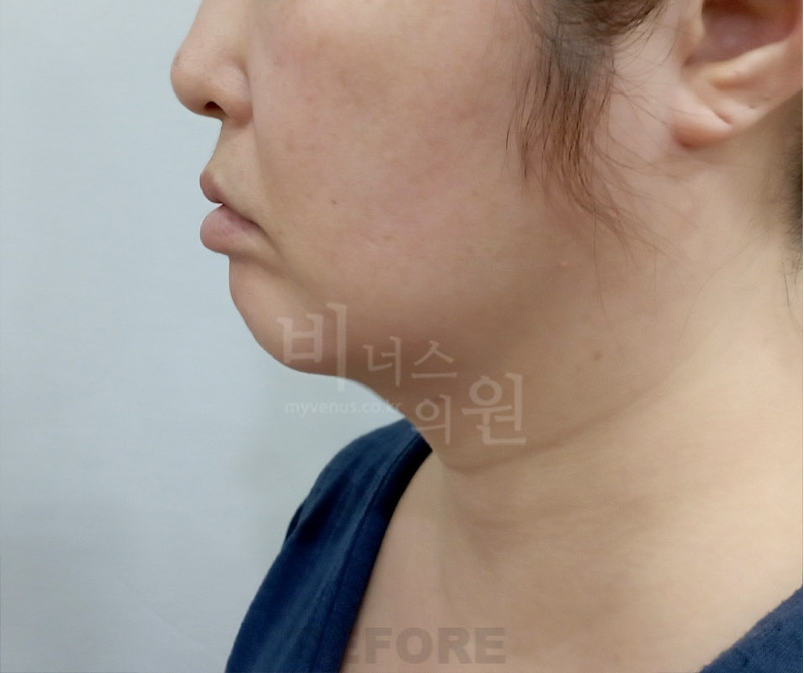 이중턱 지방흡입 수술 전 좌측면