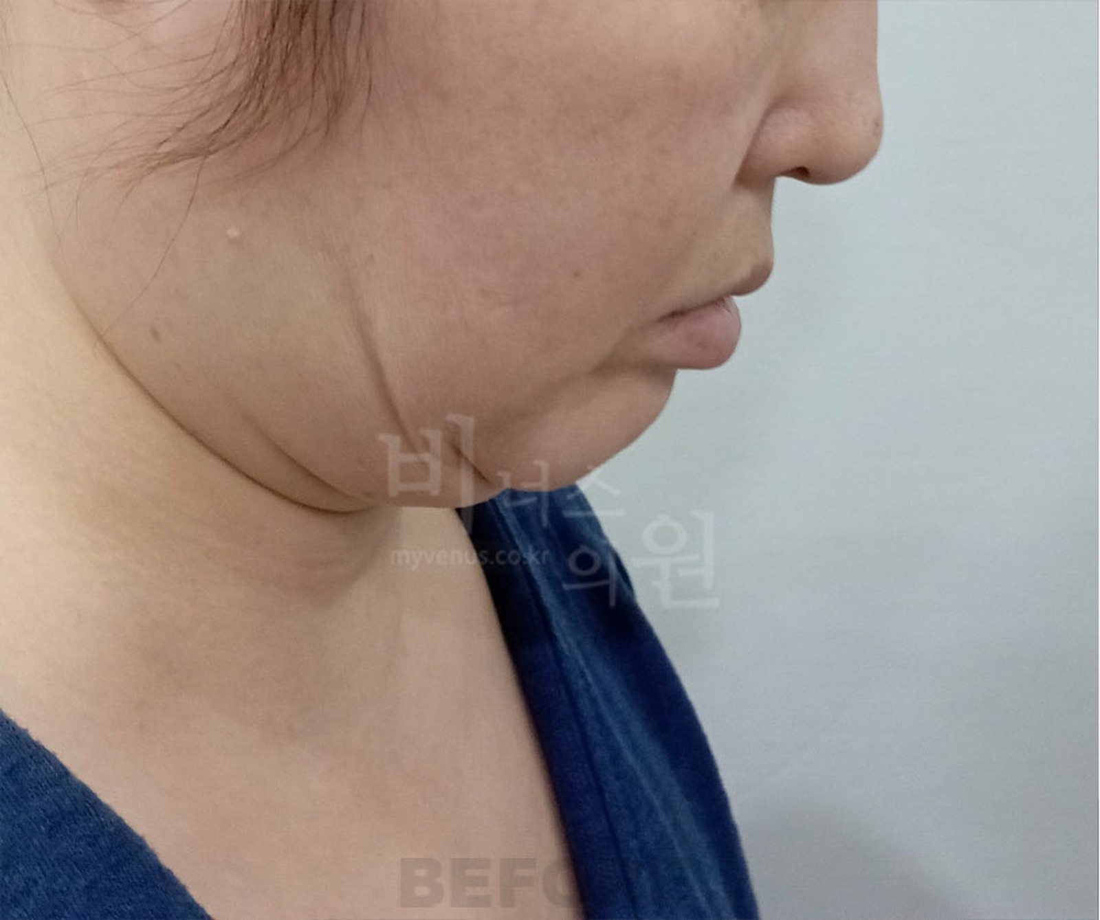 이중턱 지방흡입 수술 전 우측면