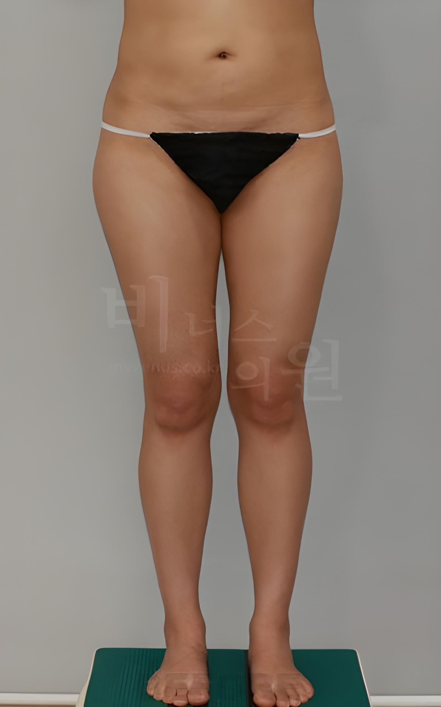 엉덩이 볼륨업 지방흡입 수술 전 정면