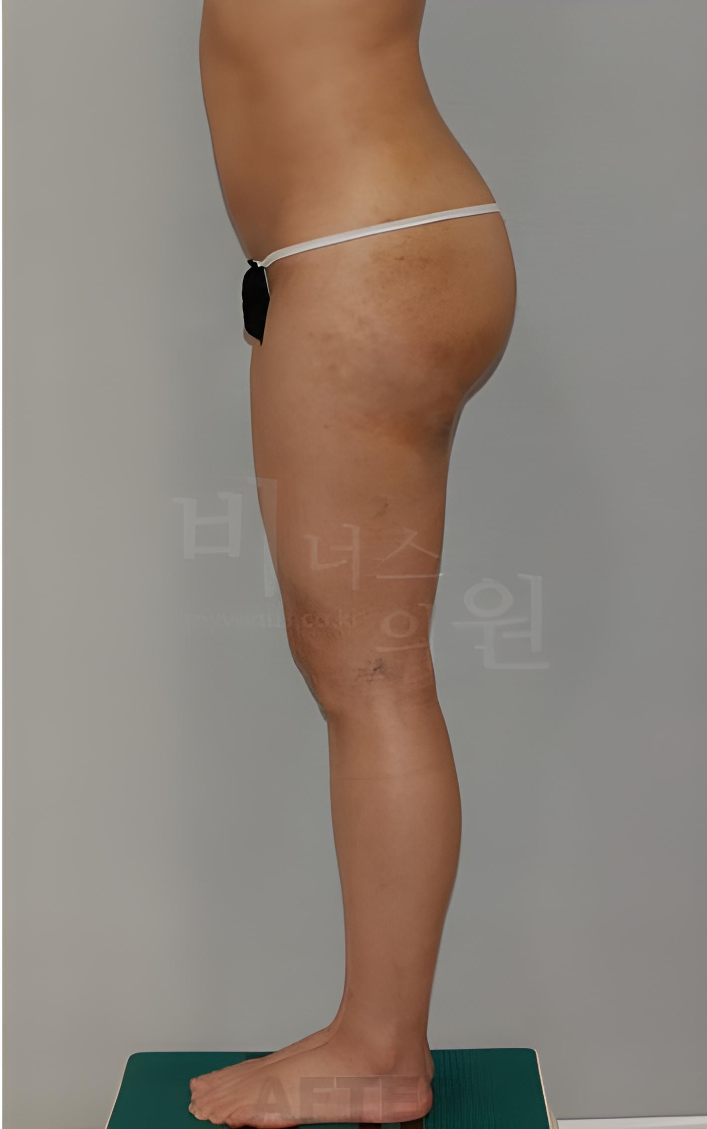 엉덩이 볼륨업 지방흡입 수술 후 측면 왼쪽