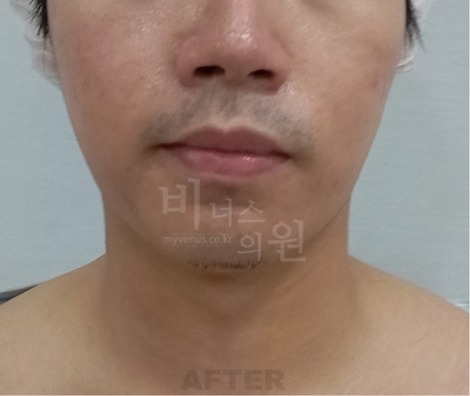 이중턱 목 지방흡입 남성 정면 수술 후