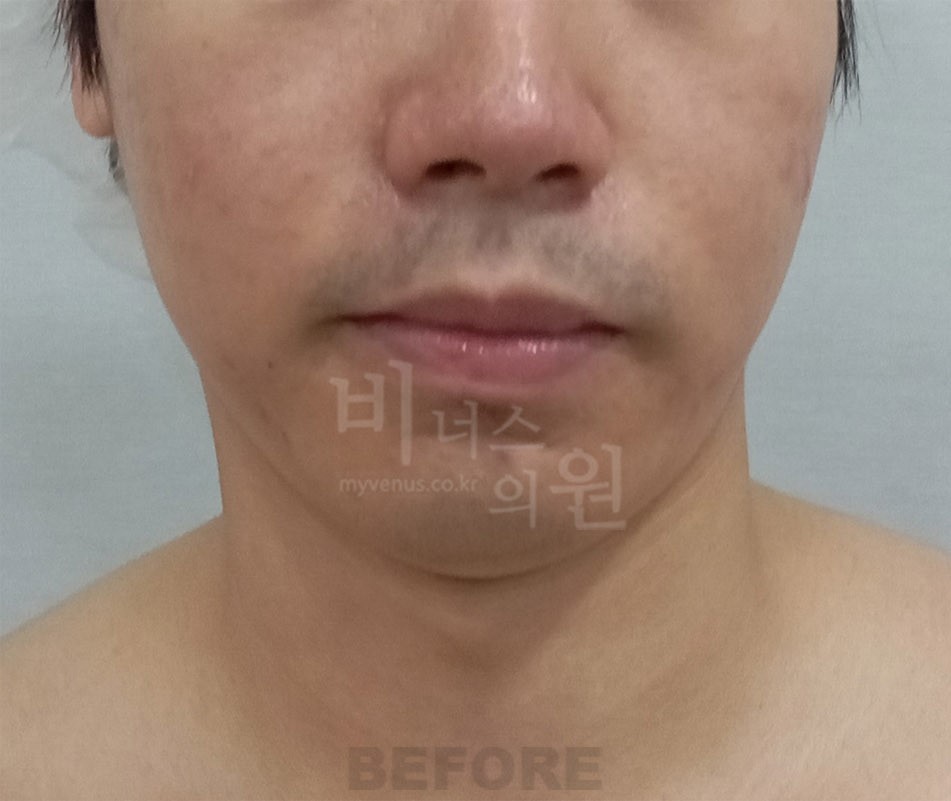 이중턱 목 지방흡입 남성 정면 수술 전