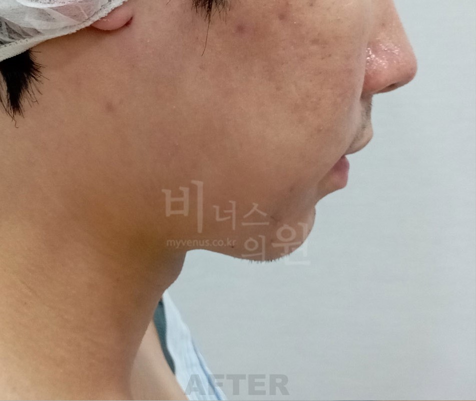 이중턱 목 지방흡입 남성 좌측면 수술 후