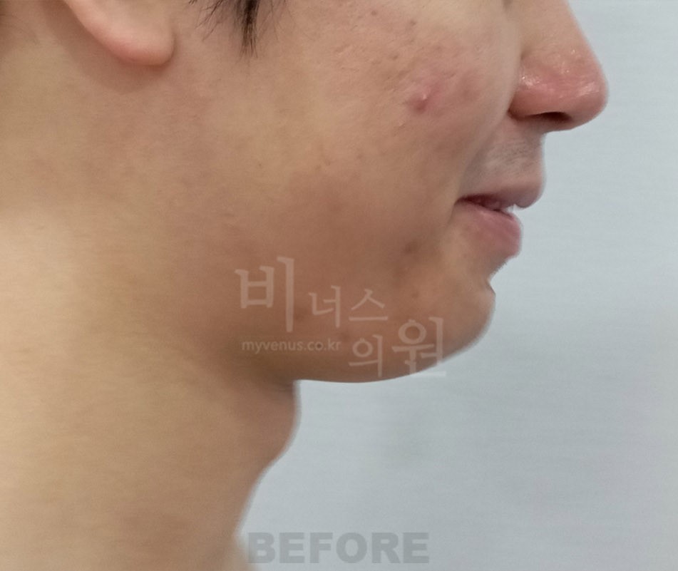 이중턱 목 지방흡입 남성 좌측면 수술 전