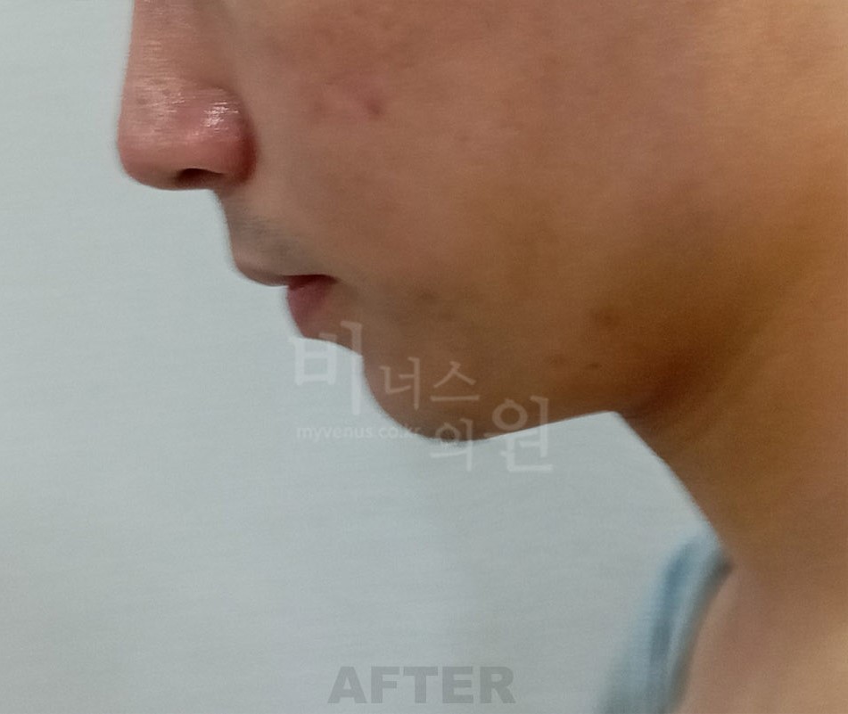 이중턱 목 지방흡입 남성 우측면 수술 후