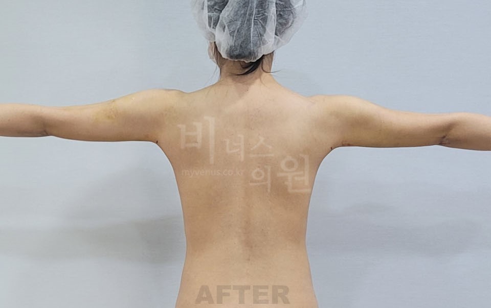 팔뚝 지방흡입 수술 후 후면 팔을 옆으로 벌린 자세