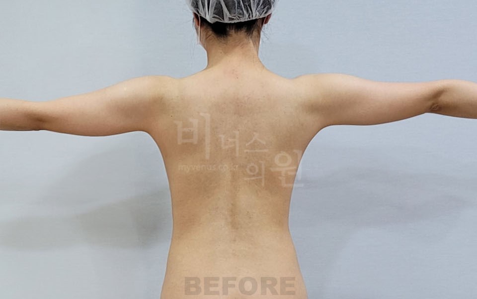 팔뚝 지방흡입 수술 전 후면 팔을 옆으로 벌린 자세