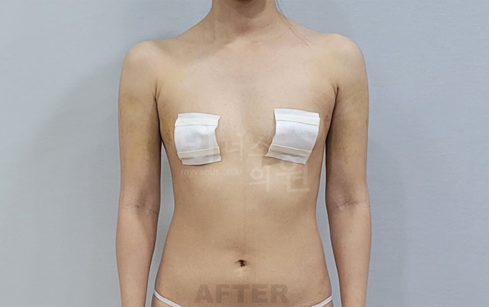 팔뚝 지방흡입 수술 후 정면 팔을 내린 자세