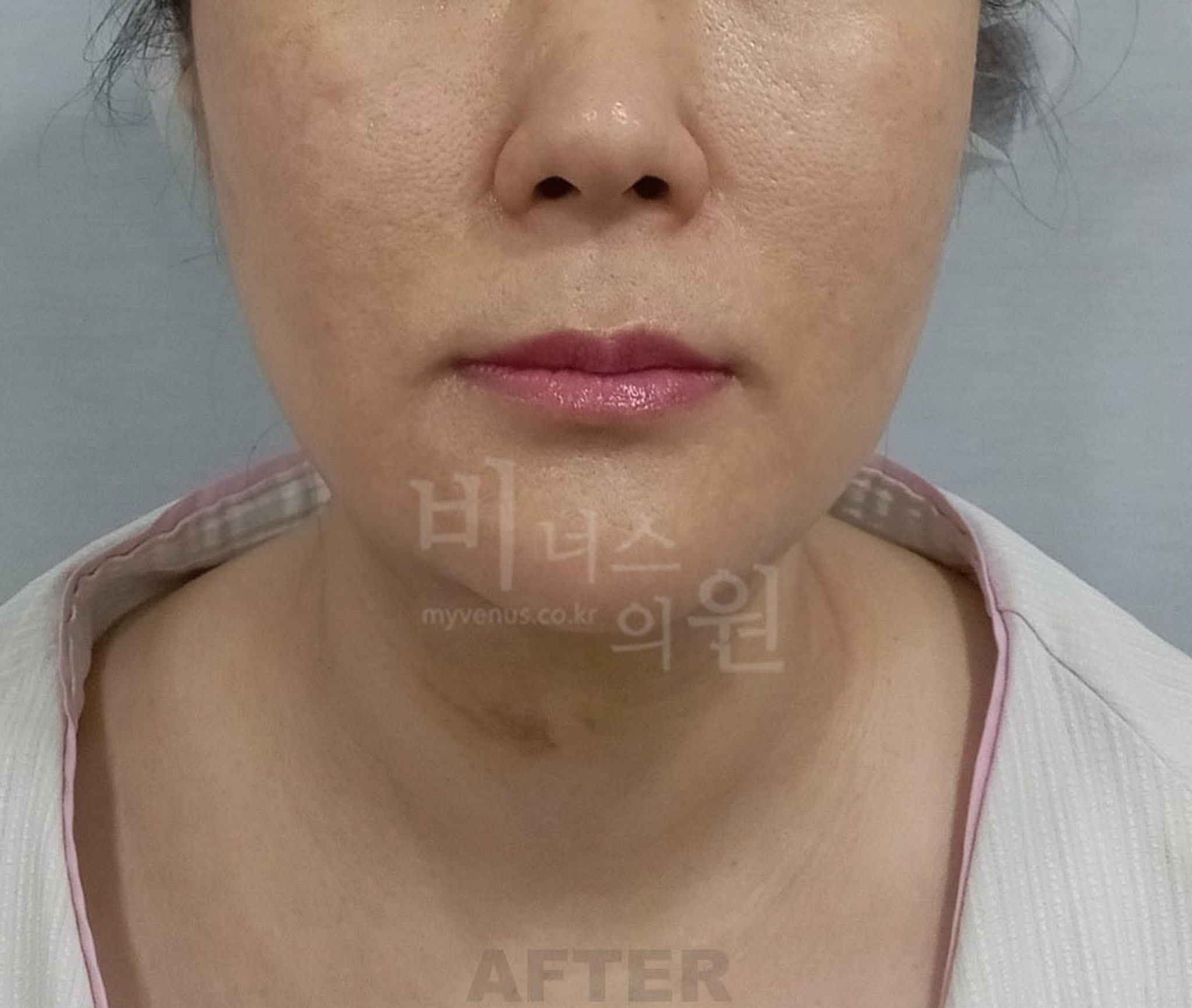 얼굴·턱 지방흡입 수술 후 정면 사진