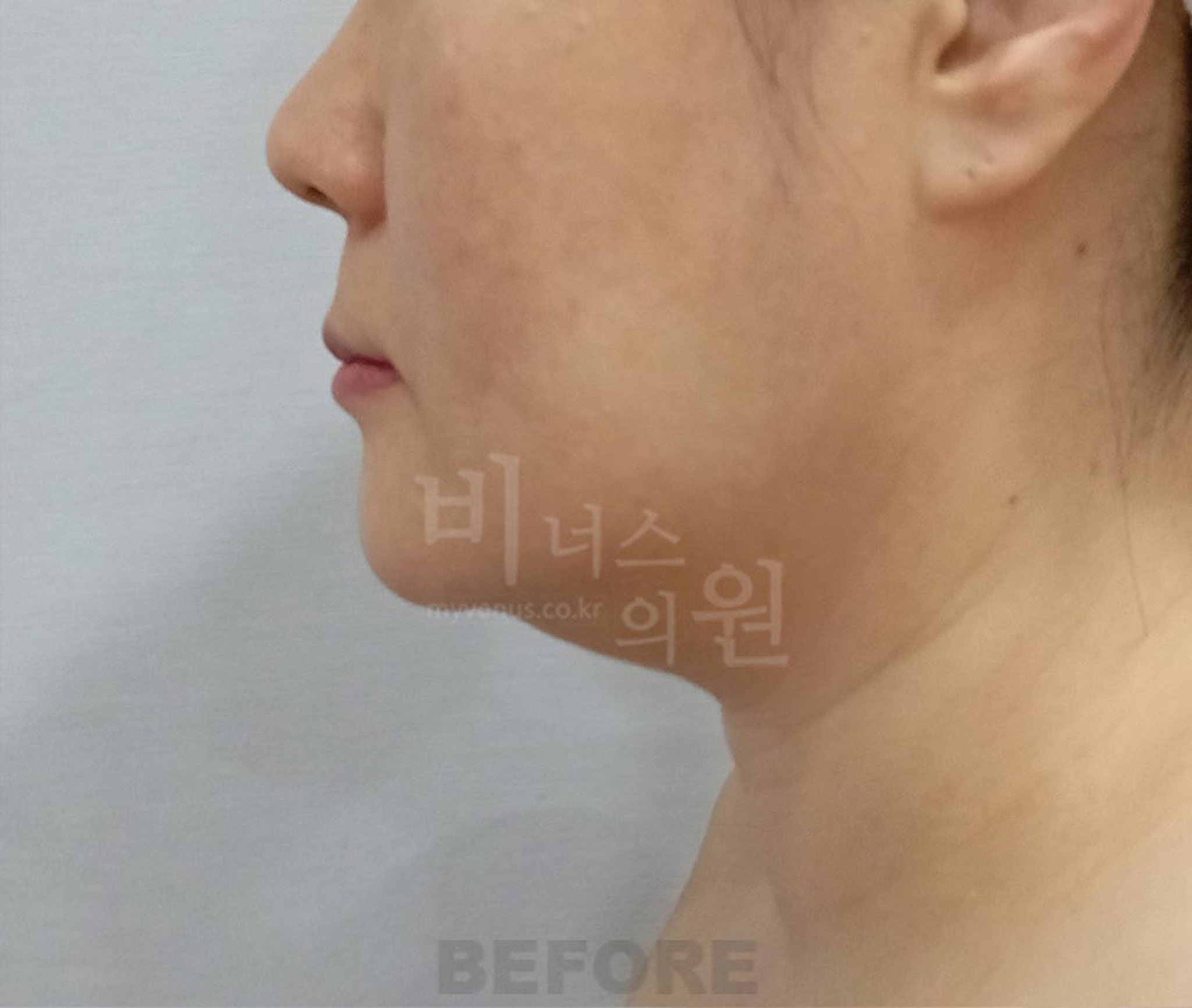 얼굴·턱 지방흡입 수술 전 측면 ① 사진