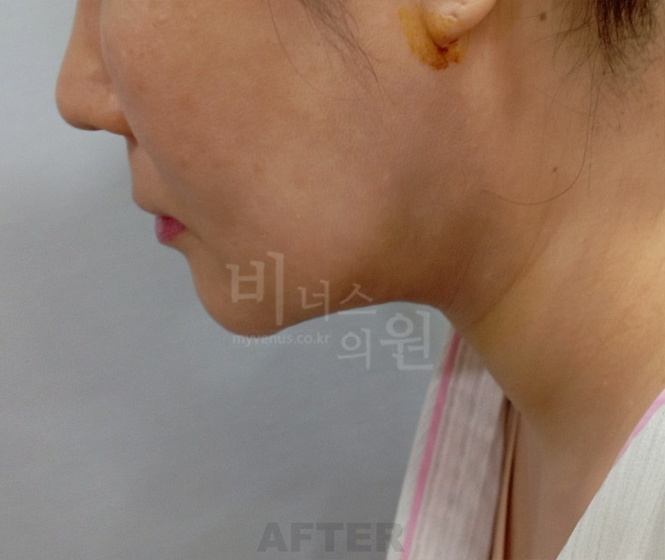 얼굴·턱 지방흡입 수술 후 측면 ② 사진