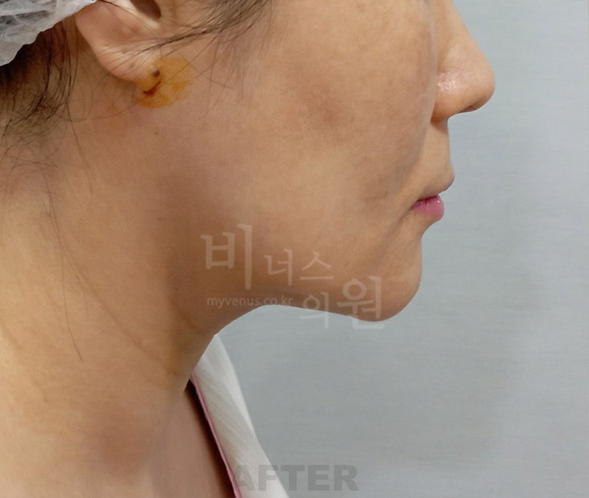얼굴·턱 지방흡입 수술 후 반대쪽 측면 사진