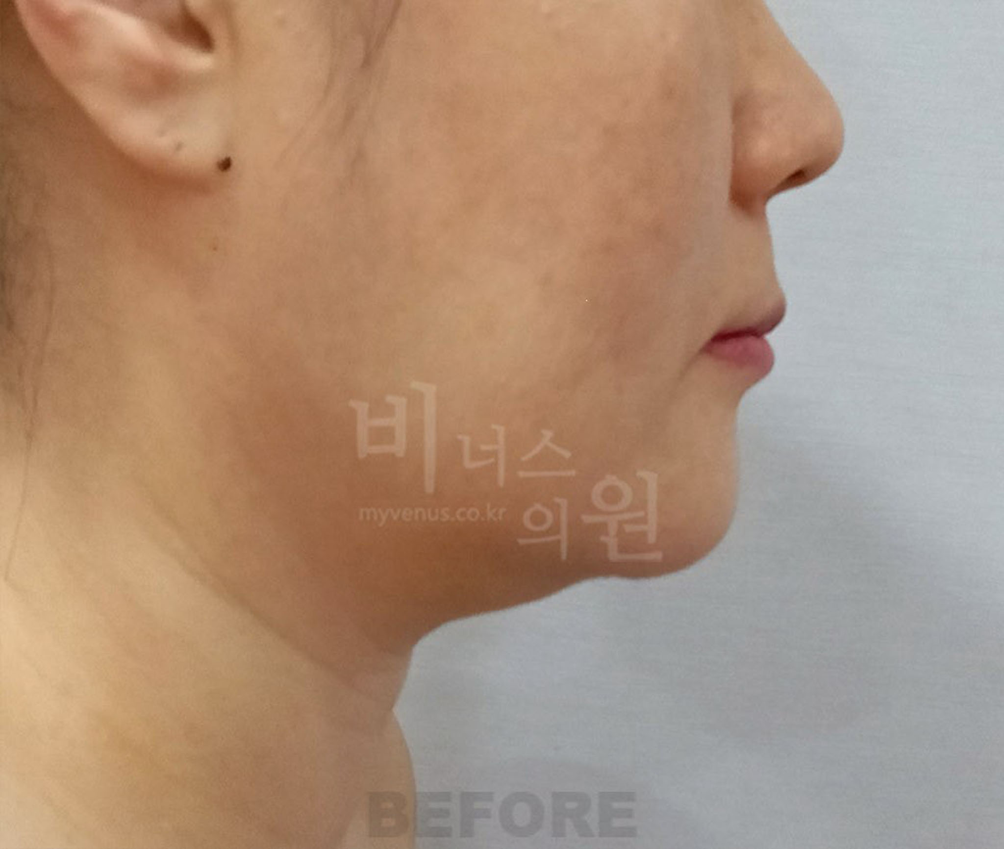 얼굴·턱 지방흡입 수술 전 반대쪽 측면 사진