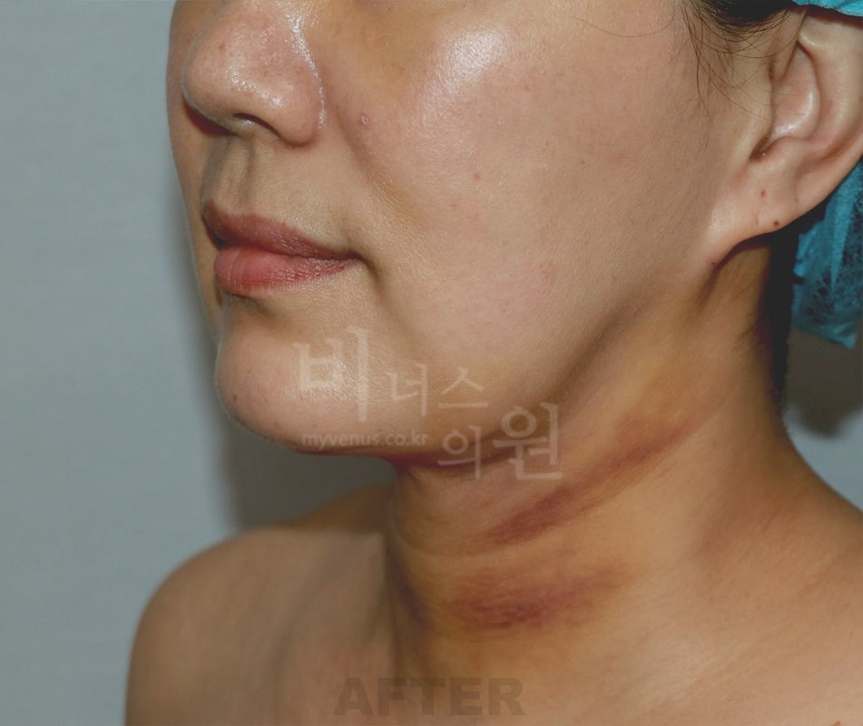 턱지방흡입 수술 후 45도 측면 — 부천 상동역 비너스의원 2021년 촬영 동일인