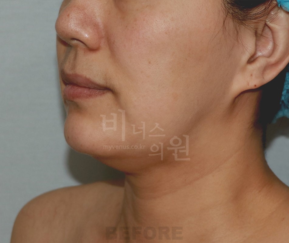 턱지방흡입 수술 전 45도 측면 — 부천 상동역 비너스의원 2021년 촬영 동일인
