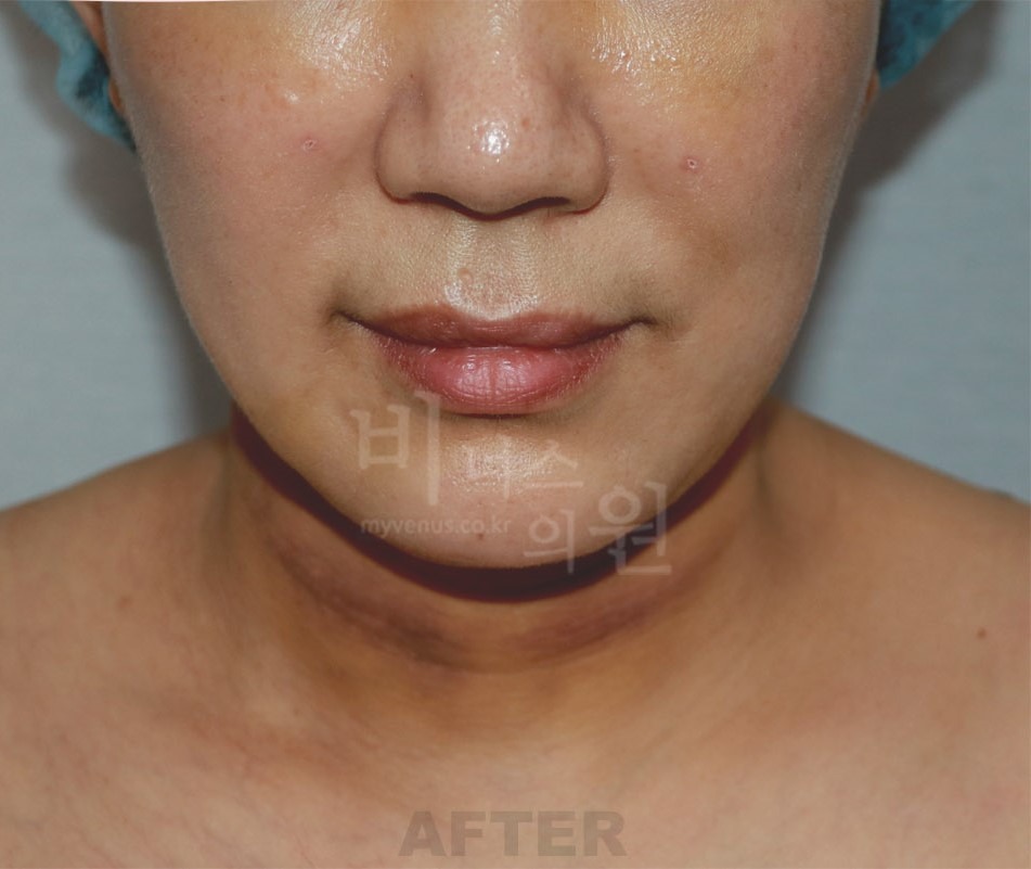 턱지방흡입 수술 후 정면 — 부천 상동역 비너스의원 2021년 촬영 동일인