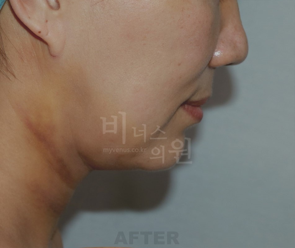 턱지방흡입 수술 후 측면 — 부천 상동역 비너스의원 2021년 촬영 동일인