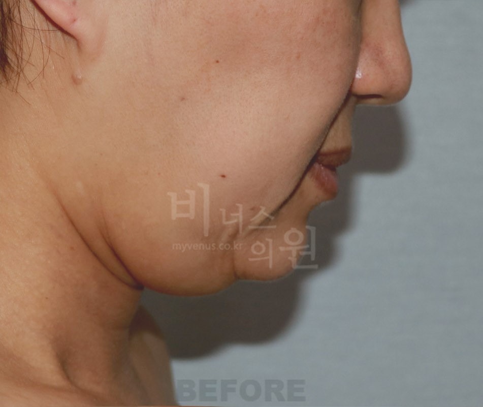 턱지방흡입 수술 전 측면 — 부천 상동역 비너스의원 2021년 촬영 동일인