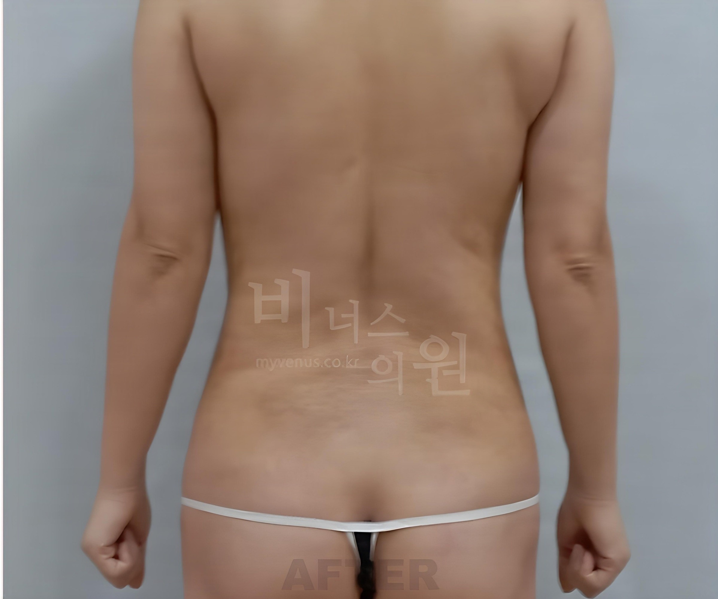 복부 지방흡입 수술 후 후면
