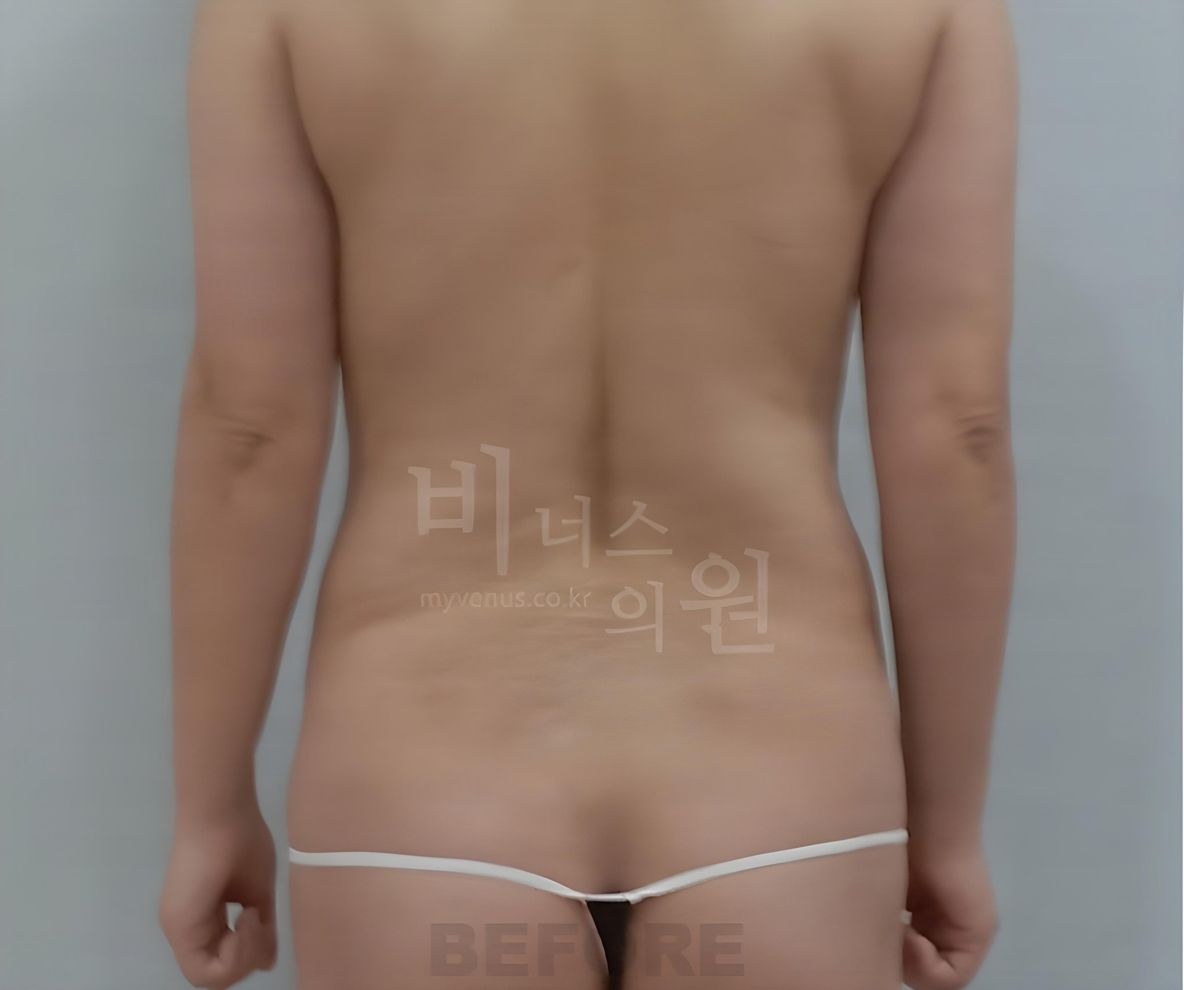복부 지방흡입 수술 전 후면